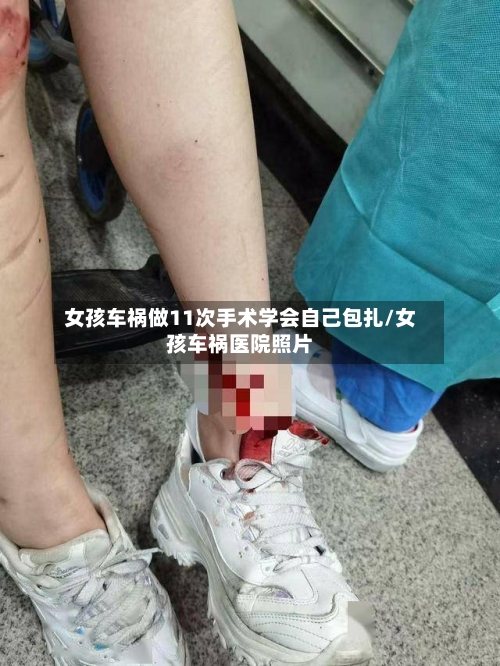 女孩车祸做11次手术学会自己包扎/女孩车祸医院照片-第2张图片
