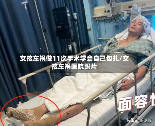 女孩车祸做11次手术学会自己包扎/女孩车祸医院照片