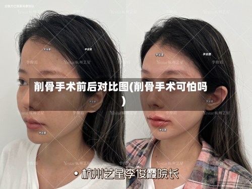 削骨手术前后对比图(削骨手术可怕吗)