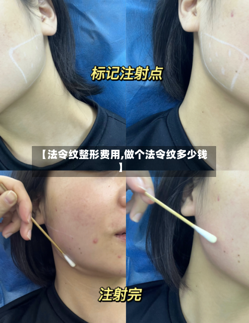 【法令纹整形费用,做个法令纹多少钱】-第3张图片